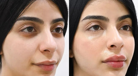 Antes y despues del contorno de ojos: ojeras y bolsas reducidas