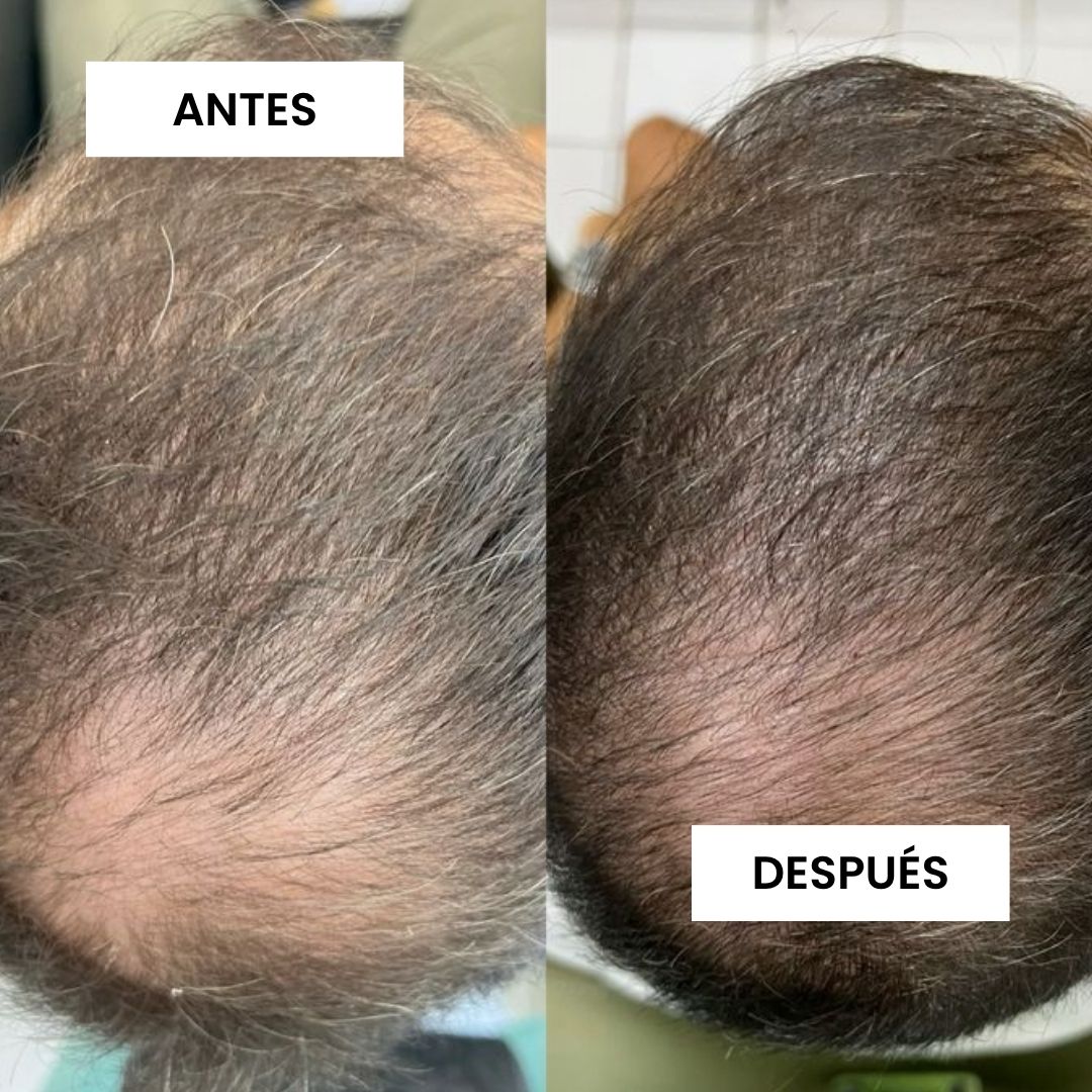 KIT FUNDADOR · CRECE — Caída del cabello