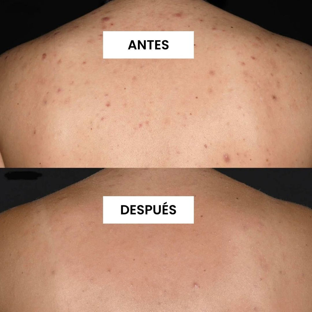 KIT FUNDADOR · CARA LIMPIA — Acné y puntos negros
