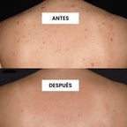 KIT FUNDADOR · CARA LIMPIA — Acné y puntos negros