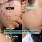 KIT· CARA LIMPIA — Acné y puntos negros