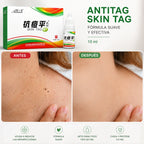 AONISEN SKIN TAG FRAS X 15 ML