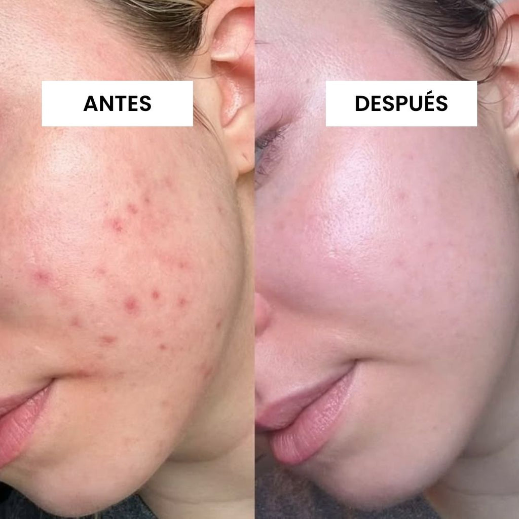 KIT FUNDADOR · CARA LIMPIA — Acné y puntos negros