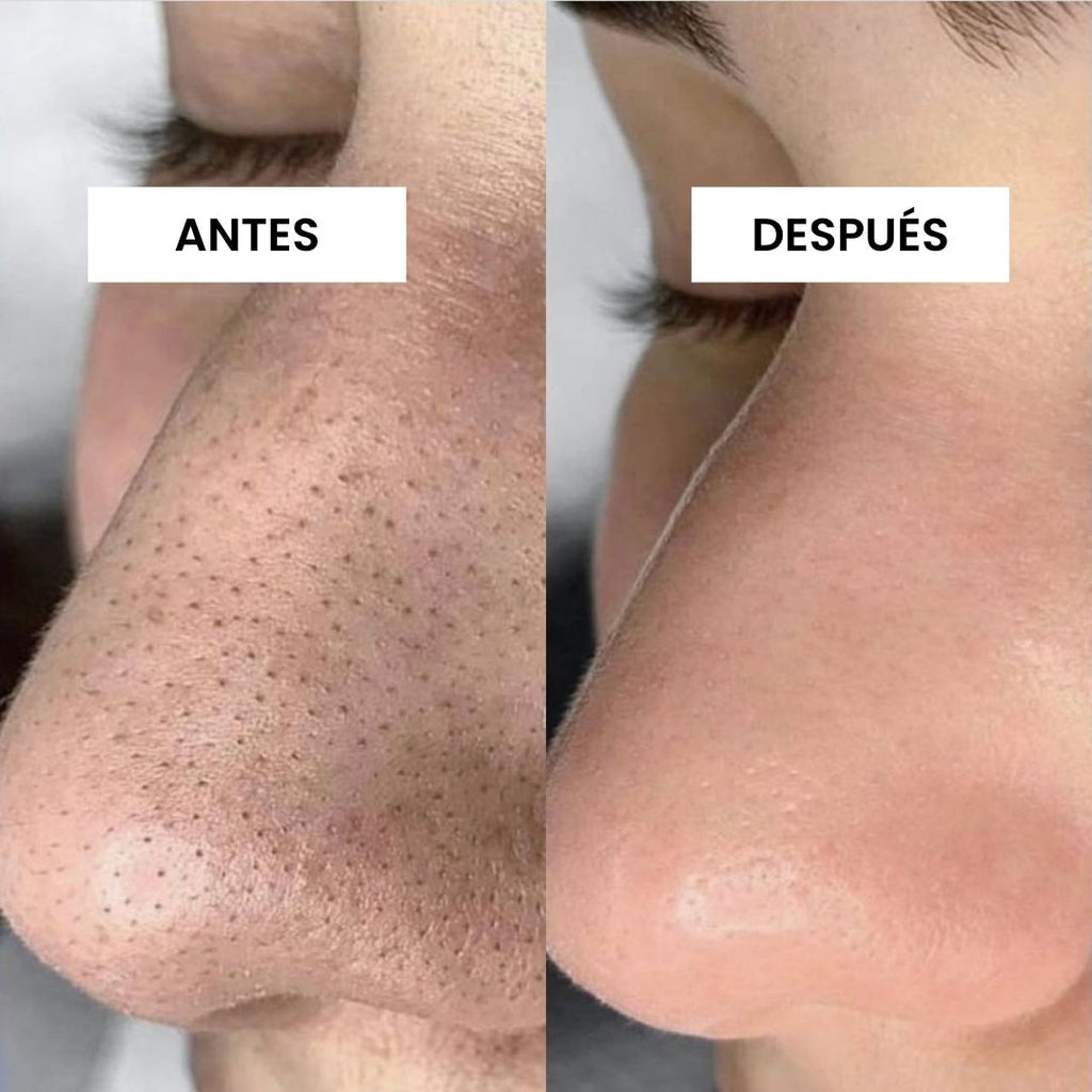 KIT FUNDADOR · CARA LIMPIA — Acné y puntos negros
