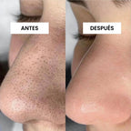 KIT FUNDADOR · CARA LIMPIA — Acné y puntos negros