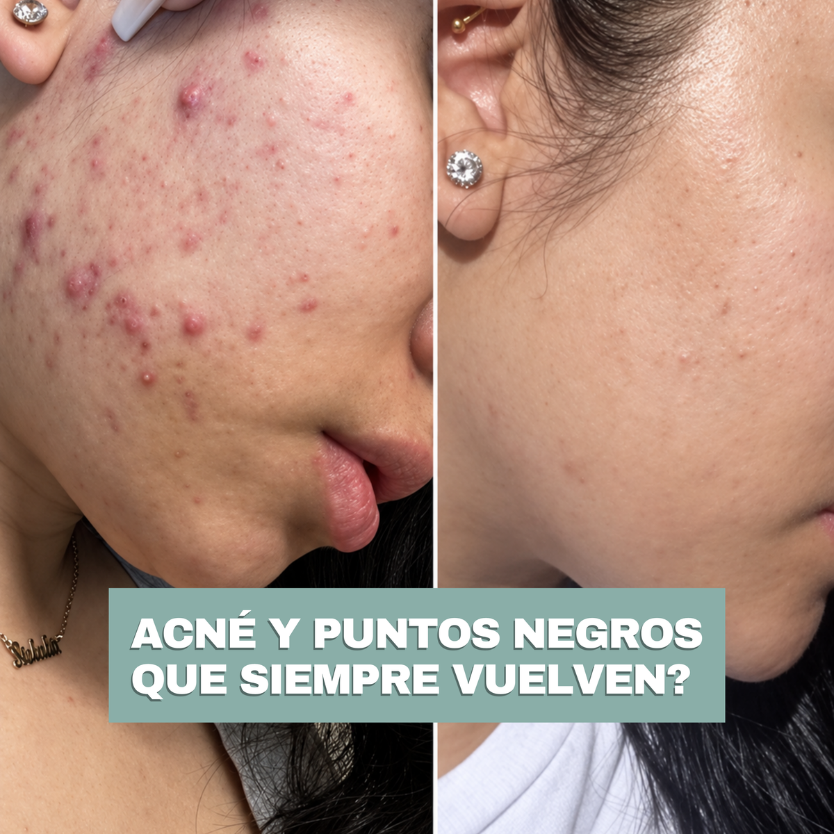 KIT· CARA LIMPIA — Acné y puntos negros