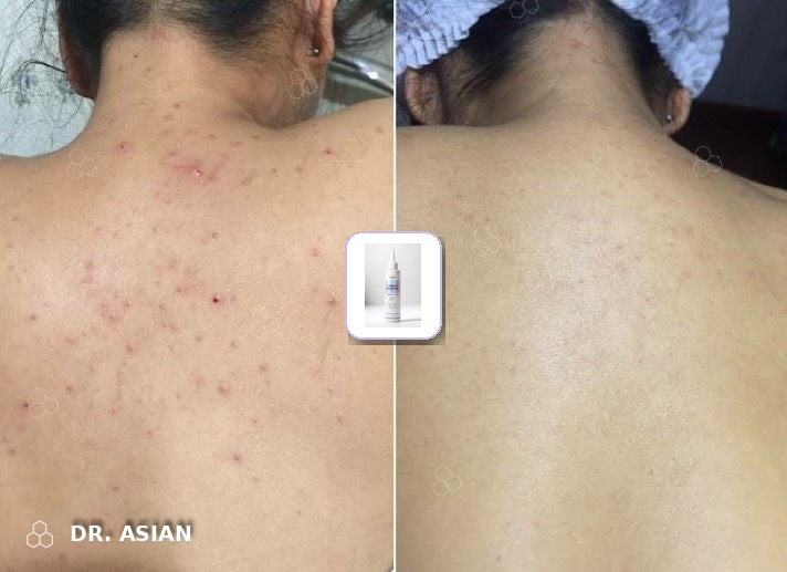 Acné en la espalda antes y después del Tónico de Ácido Glicólico Dr. Asian