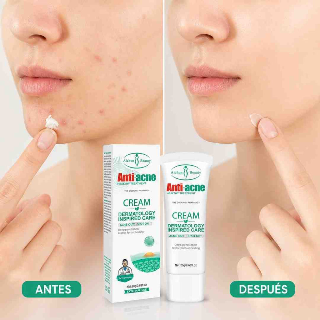 Aichun Beauty Antiacne 20G - Blondas Cosmeticos | Blondas Paraguay