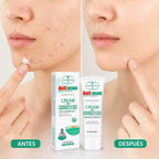 Aichun Beauty Antiacne 20G - Blondas Cosmeticos | Blondas Paraguay