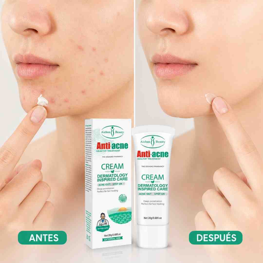 Aichun Beauty Antiacne 20G - Blondas Cosmeticos | Blondas Paraguay