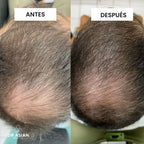 KIT· CRECE — Caída del cabello