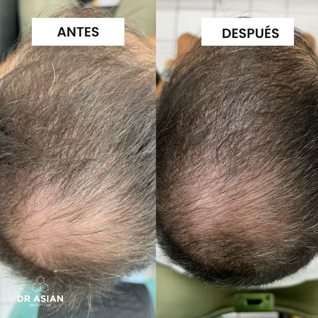 KIT· CRECE — Caída del cabello