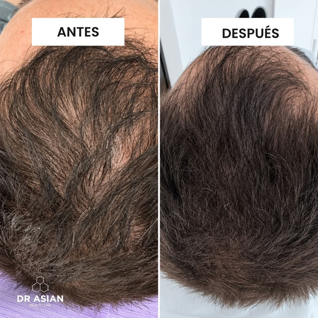 KIT· CRECE — Caída del cabello