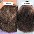 KIT· CRECE — Caída del cabello