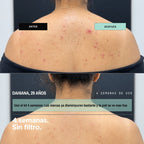KIT· CARA LIMPIA — Acné y puntos negros