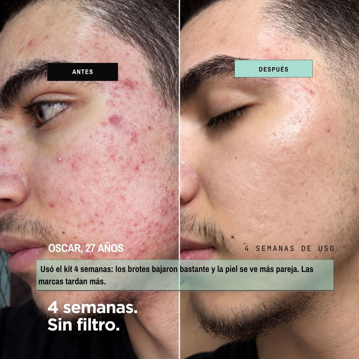 KIT· CARA LIMPIA — Acné y puntos negros