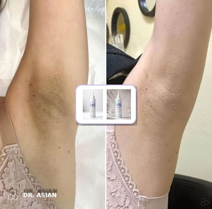 Axilas oscuras antes y después del Tónico de Ácido Glicólico Dr. Asian