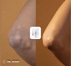 Codos oscuros antes y después con ácido glicólico Dr. Asian