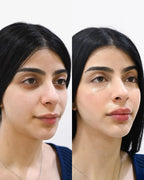 Antes y después del Contorno de Ojos Bendita Tú Eres: ojeras y bolsas reducidas