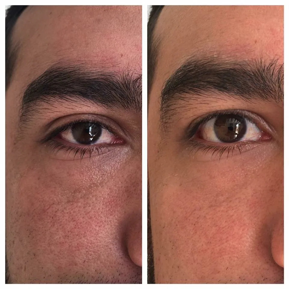 Contorno de ojos en hombres: antes y después