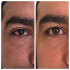 Contorno de ojos en hombres: antes y después