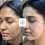 Antes y después de manchas en el rostro con el Tónico de Ácido Glicólico Dr. Asian