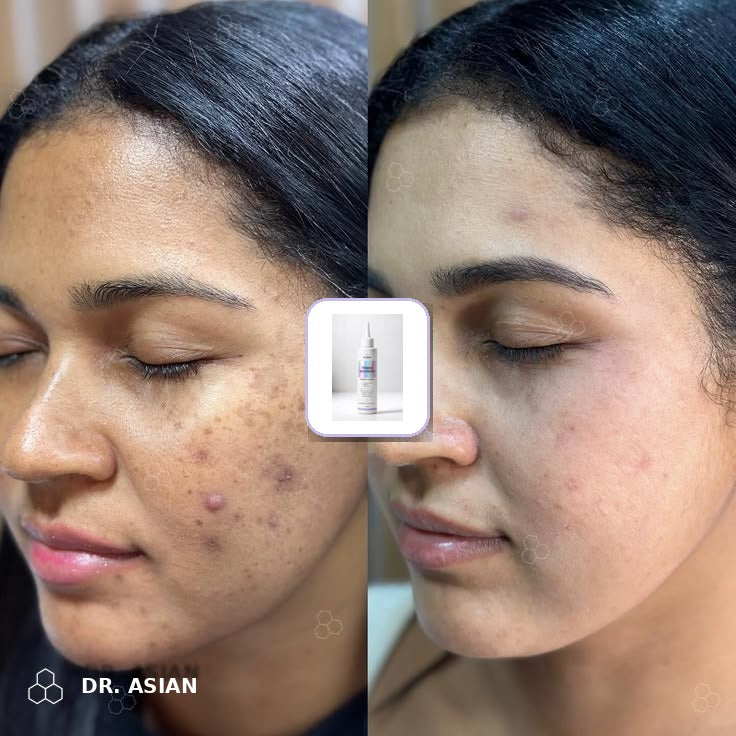 Antes y después de manchas en el rostro con el Tónico de Ácido Glicólico Dr. Asian