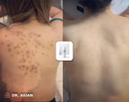 Marcas de acné en la espalda antes y después con el Tónico de Ácido Glicólico Dr. Asian