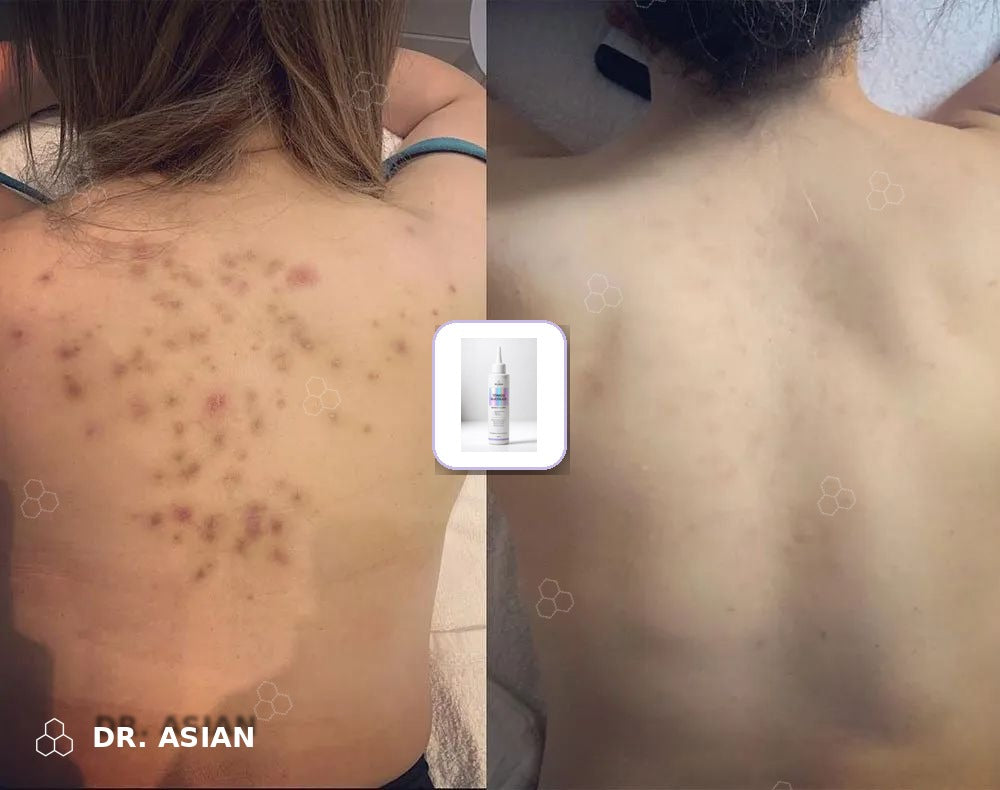 Marcas de acné en la espalda antes y después con el Tónico de Ácido Glicólico Dr. Asian