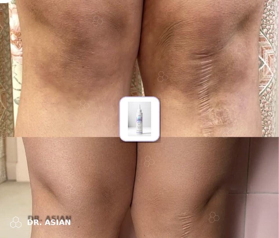 Rodillas oscuras antes y después del Tónico de Ácido Glicólico Dr. Asian